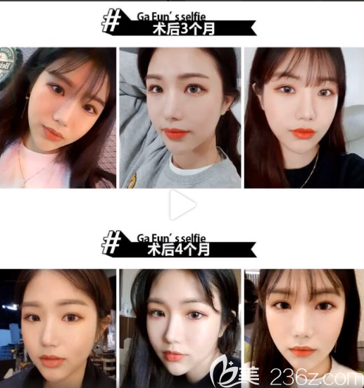 臉本臉骨整形外科樸用南顴骨案例