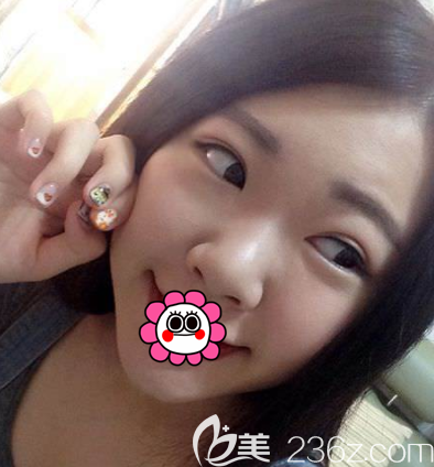 我在北京新星靚做完眼綜合大概半個(gè)月左右就基本消腫了