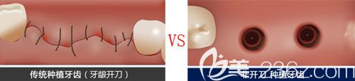 韓國來一菲不開刀種植牙與普通種植牙區(qū)別