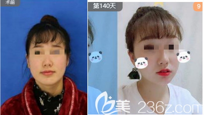 煙臺(tái)洛神鼻綜合案例