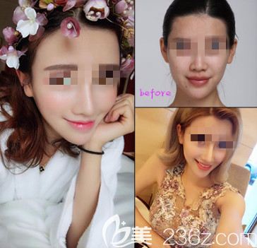 煙臺(tái)鵬愛鼻綜合案例