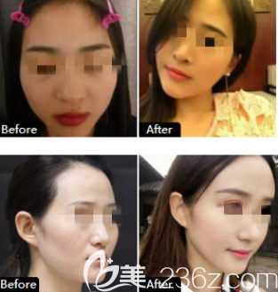 煙臺(tái)美神鼻綜合案例