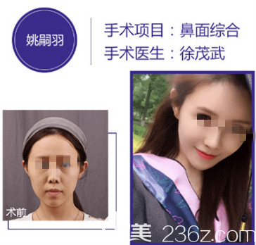 煙臺(tái)華怡鼻綜合案例