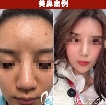 煙臺(tái)王玉珍鼻綜合案例