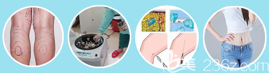 廣州星團(tuán)醫(yī)美趙輝醫(yī)生吸脂手術(shù)過(guò)程圖 廣州星團(tuán)醫(yī)美趙輝醫(yī)生吸脂手術(shù)過(guò)程圖