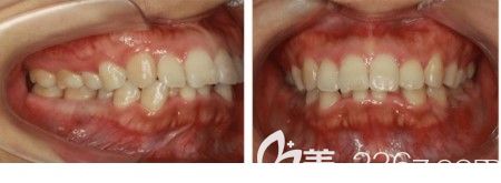 矯正前口腔內(nèi)的牙齒情況
