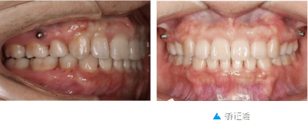打支抗釘矯正的效果圖