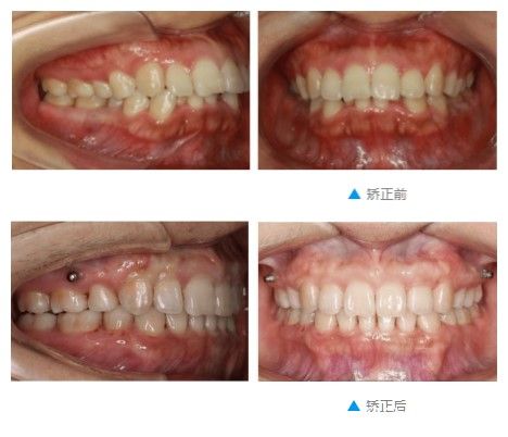 在重慶齊美口腔做完深覆合及齙牙矯正前后對(duì)比照