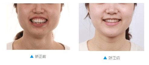 關(guān)于重慶齊美口腔怎么樣?還是看下深覆合+齙牙的我在這里做過(guò)正雅隱形牙齒矯正后的點(diǎn)評(píng)吧