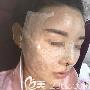 剛做完自體脂肪填充面部術(shù)后即刻