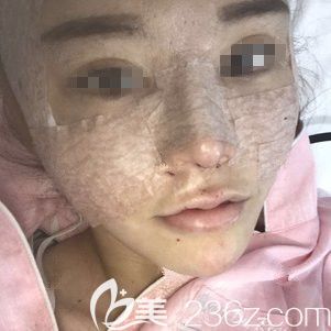 術(shù)后四天面部脂肪填充消腫恢復(fù)