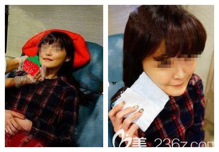 醫(yī)生十幾分鐘瘦臉注射后冰敷