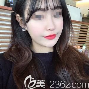 瘋狂打call常州美貝爾微整醫(yī)生 僅用了100單位國產(chǎn)蘭州就改變了我19年的嘟嘟臉