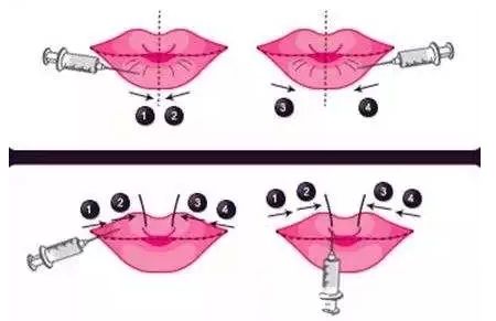 韓國(guó)注射嘟嘟唇
