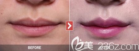 韓國(guó)女神整形外科微笑唇案例