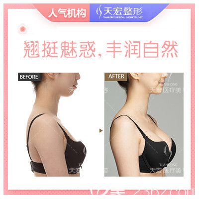 張家口天宏自體脂肪動態(tài)豐胸案例