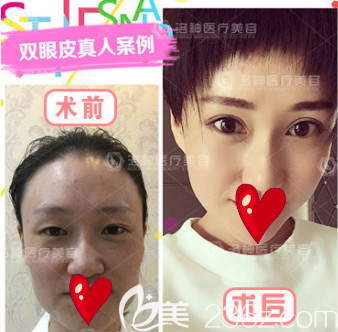 煙臺(tái)洛神全切雙眼皮案例