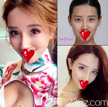 煙臺(tái)鵬愛(ài)整形醫(yī)院全切雙眼皮案例