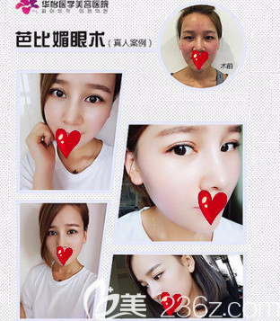 煙臺(tái)華怡全切雙眼皮案例