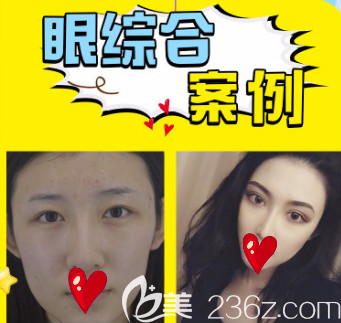 煙臺(tái)王玉珍全切雙眼皮案例