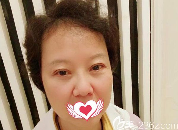 內(nèi)切去眼袋20天眼袋消失了，淚溝也跟著淡化了