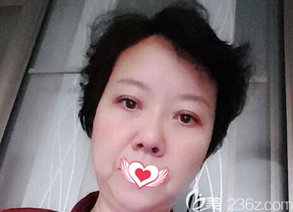 自體脂肪填充淚溝一個月脂肪成活率很高