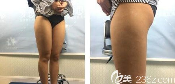 在昆明夢想做吸脂手術(shù)前 在昆明夢想做吸脂手術(shù)前