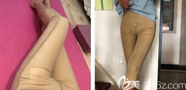 大腿抽脂第9天吸脂的傷口還在慢慢愈合 大腿抽脂第9天吸脂的傷口還在慢慢愈合