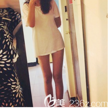 東莞華美大腿吸脂減肥一個月效果