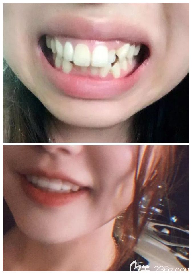 齙牙矯正正面對比凸 齙牙矯正正面對比凸
