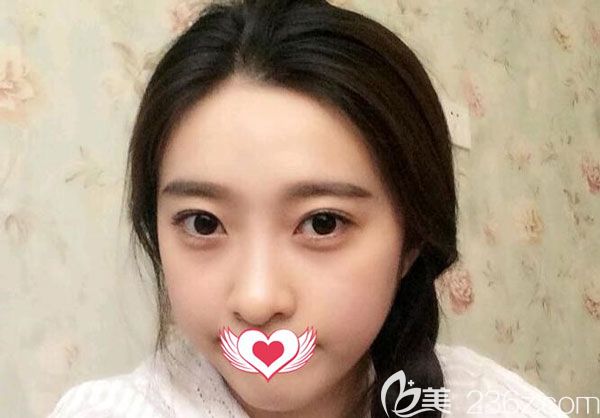 玻尿酸填充下巴第7天沒有移位的現(xiàn)象