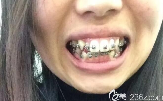 沈陽盛大口腔齙牙矯正初戴牙套樣子 沈陽盛大口腔齙牙矯正初戴牙套樣子