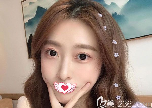 找昆明韓辰做玻尿酸填充下巴,才調(diào)整到現(xiàn)在這個(gè)樣子,不僅沒有移位價(jià)格還很合理