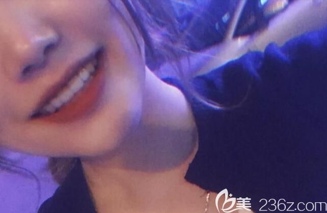 曬曬我在沈陽盛大口腔齙牙矯正后的臉型變化圖，妹子們覺得我矯正齙牙后變漂亮了嗎