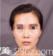 隆鼻術(shù)前的照片 隆鼻術(shù)前的照片