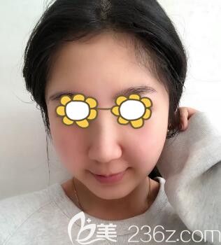 在沈陽做鼻整形術(shù)后一周拆線 在沈陽做鼻整形術(shù)后一周拆線