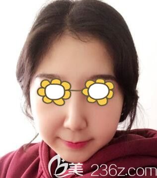 在沈陽名流做鼻整形術(shù)后半個(gè)月恢復(fù)效果 在沈陽名流做鼻整形術(shù)后半個(gè)月恢復(fù)效果