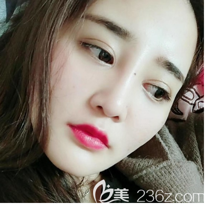 佛山夢(mèng)露孫文娜醫(yī)生雙眼皮隆鼻<span style= 佛山夢(mèng)露孫文娜醫(yī)生雙眼皮隆鼻<span style=