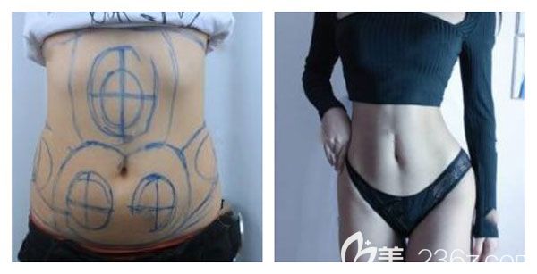 昆明韓辰李寧腰腹部吸脂案例效果對比圖