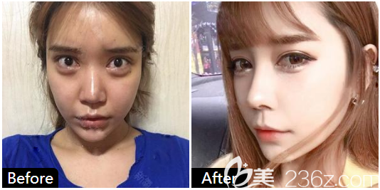 廣州<!--<i data=20240703-sp></i>-->做的隆鼻 廣州<!--<i data=20240703-sp></i>-->做的隆鼻