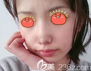 寧波美萊隆鼻案例7天拆線效果