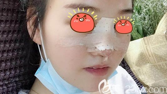 寧波美萊肋軟骨隆鼻案例即刻效果