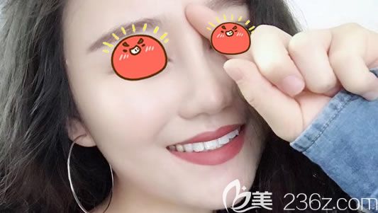 寧波美萊做肋軟骨隆鼻7天后