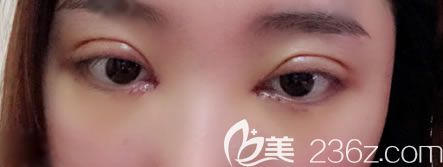 寧波薇琳雷艷莉雙眼皮<span style=