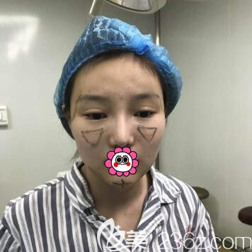 做自體脂肪全臉填充術(shù)前畫(huà)線設(shè)計(jì) 做自體脂肪全臉填充術(shù)前畫(huà)線設(shè)計(jì)