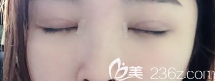 寧波薇琳雙眼皮手術(shù)疤痕恢復(fù)照片
