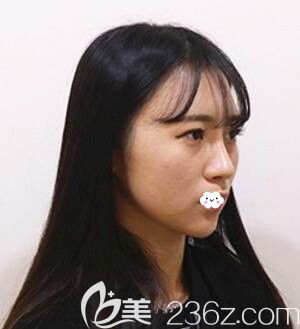 臉部吸脂多久可以見人？不想磨骨瘦臉找韓國raffine醫(yī)院做下頜緣面部吸脂擁有V臉恢復(fù)圖見證