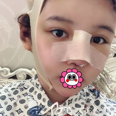 王丹丹做完隆鼻和面部脂肪填充術(shù)后即刻 王丹丹做完隆鼻和面部脂肪填充術(shù)后即刻