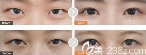 韓國MVP眼部整形案例
