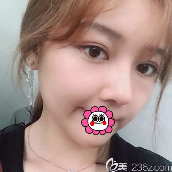 面部條件不錯的我找哈爾濱臻美王丹丹做了硅膠隆鼻+自體脂肪填充后五官更加立體